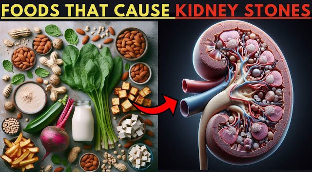 What Foods Cause Kidney Stones